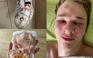 Оприлюднили відео з лікарні у якій перебуває хлопець, якого ТЦК на Закарпатті побили та довели до самогубства (18+)